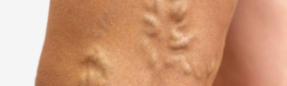 ŻYLAKI – przyczyny, zapobieganie i naturalne metody leczenia